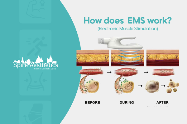 EMS treatment for post pregnancy weight loss treatment Perth
