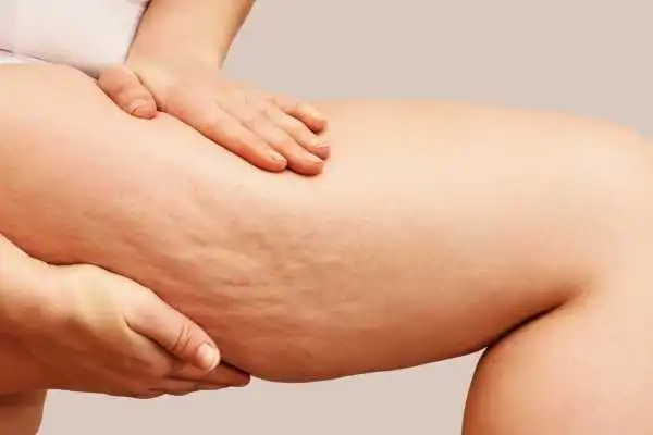 Image of woman showing leg with cellulite Perth