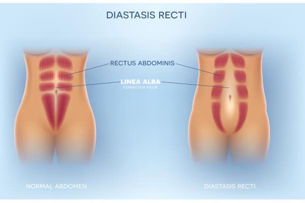 What Non-Surgical Options Are Available for Diastasis Recti Perth?
