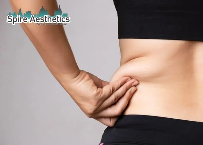 Image of woman pinching fat on their hips Perth. Fat Freezing treatment