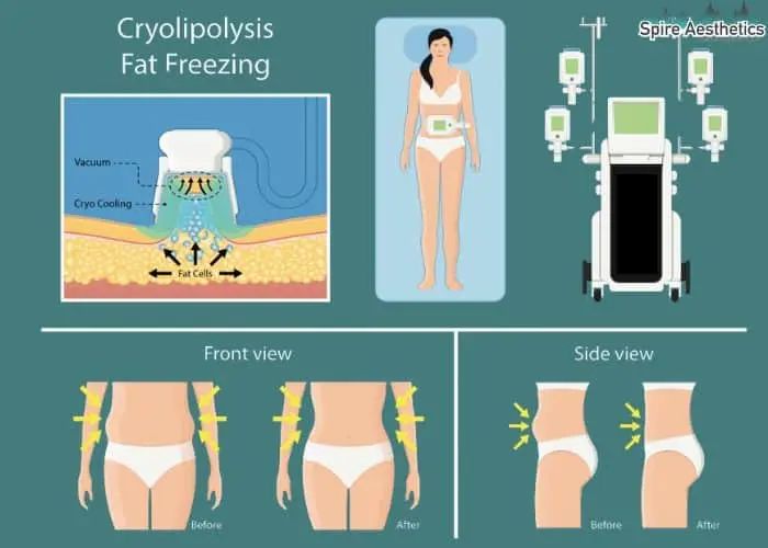 Fat freezing treatment Perth benefits for competitions to remove stubborn fat deposits.