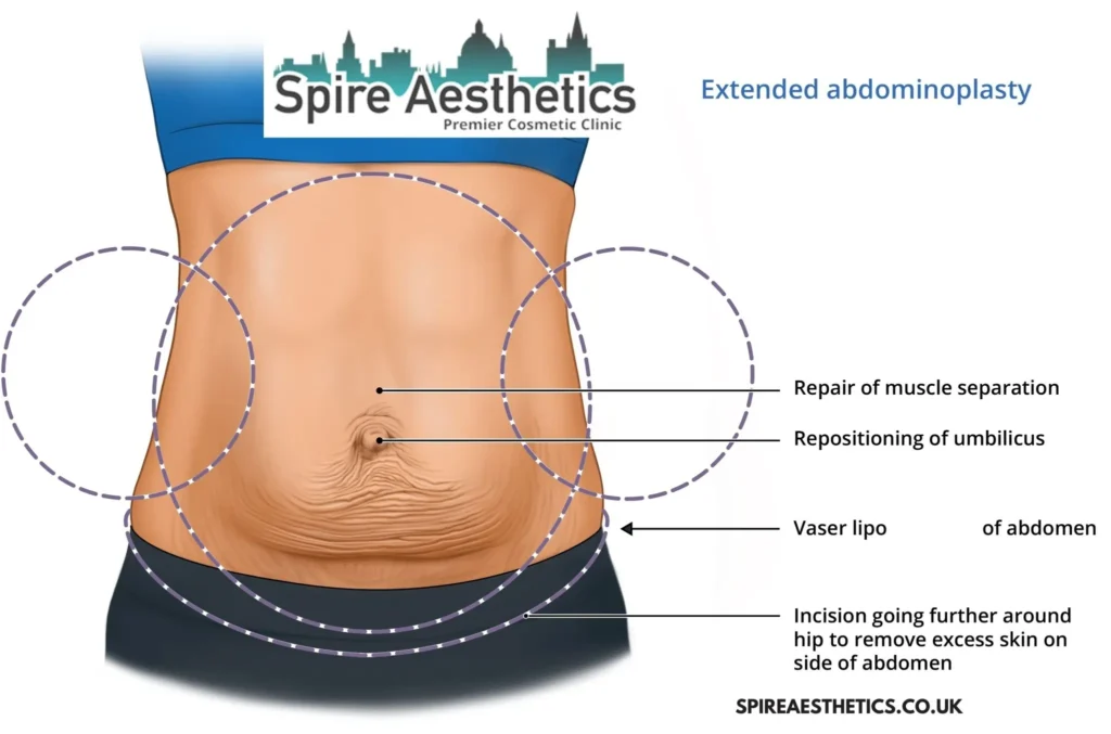 Understanding Loose Skin After Gastric Band Perth Surgery and HIFU Treatment