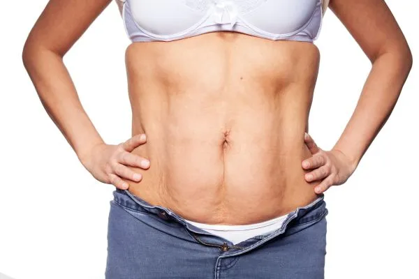 sagging skin on woman's stomach after weight loss injections Perth