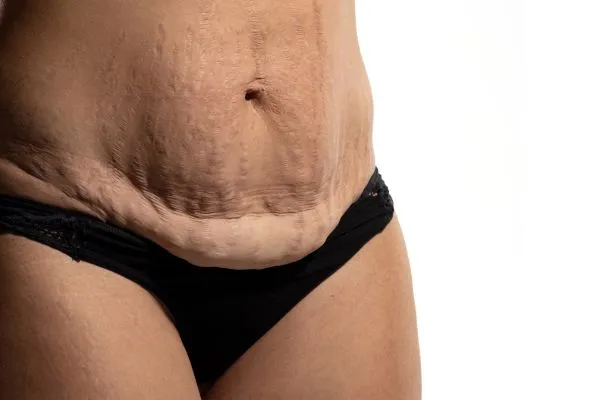 Image of womans stomach after weight loss injections Perth showing saggy skin