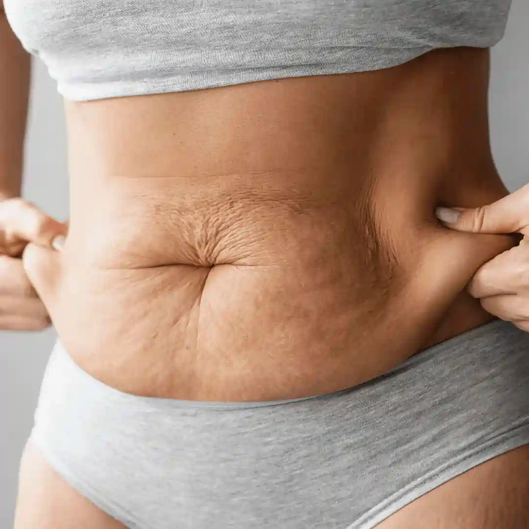 Is It Normal to Have Loose Skin After Pregnancy Perth?